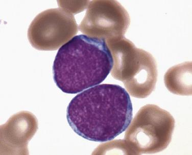 FIG. 22.39, Bone marrow aspirate smear in acute myeloid leukemia, minimally differentiated showing myeloblasts (as determined by immunophenotyping) with round nuclei containing even chromatin without distinct nucleoli and only a scant rim of agranular, basophilic cytoplasm. (Wright-Giemsa stain.)