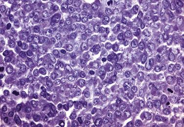 FIG. 22.40, Histologic section of a bone marrow core biopsy from a case of acute myeloid leukemia, without maturation, demonstrating sheets of myeloblasts with moderate amounts of granular cytoplasm. Differentiation past the blast stage is not observed. (Giemsa stain.)