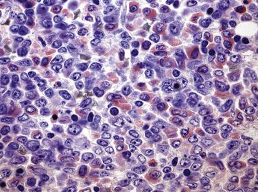 FIG. 22.41, Histologic section of a bone marrow core biopsy from a case of acute myeloid leukemia with maturation demonstrating an admixture of myeloblasts with dispersed chromatin and small, distinct nucleoli and moderate numbers of promyelocytes and myelocytes with more ample eosinophilic granular cytoplasm. (Giemsa stain.)