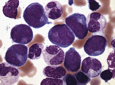 FIG. 22.42, Bone marrow aspirate smear in acute myeloid leukemia, with maturation showing myeloblasts and admixed more mature granulocytic forms. (Wright-Giemsa stain.)
