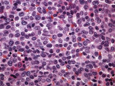 FIG. 22.43, Histologic section of a bone marrow core biopsy from a case of acute myelomonocytic leukemia demonstrating an admixture of myeloblast forms with round nuclei and distinct nucleoli, and monocytic forms with more irregular and folded nuclei. (Hematoxylin and eosin stain.)