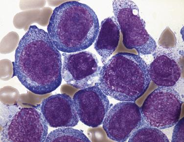 FIG. 22.44, Bone marrow aspirate smear in acute myelomonocytic leukemia showing both large monoblastic forms with round nuclei, prominent nucleoli, and basophilic cytoplasm (upper left) and smaller myeloblast forms with round nuclei, indistinct nucleoli, and small amounts of cytoplasm (lower middle) . (Wright-Giemsa stain.)