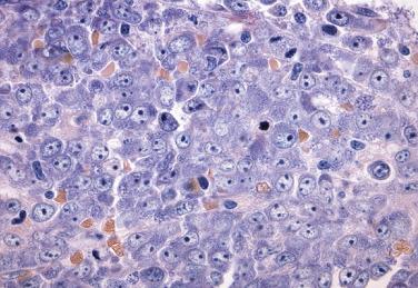 FIG. 22.45, Histologic section of a bone marrow core biopsy from a case of acute monoblastic leukemia showing sheets of large monoblasts with round nuclei, dispersed chromatin, one or two prominent nucleoli, and moderate amounts of amphophilic cytoplasm. (Giemsa stain.)