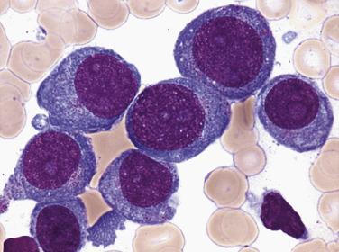 FIG. 22.46, Bone marrow aspirate smear in acute monoblastic leukemia showing large monoblast forms with round nuclei, prominent nucleoli, and basophilic cytoplasm. Note the presence of small numbers of eosinophilic cytoplasmic granules typical of monoblasts. (Wright-Giemsa stain.)