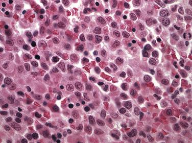 FIG. 22.47, Histologic section of a bone marrow core biopsy from a case of acute monocytic leukemia showing sheets of promonocytes with irregular, folded nuclei; indistinct nucleoli; and moderate amounts of pink cytoplasm. (Hematoxylin and eosin stain.)