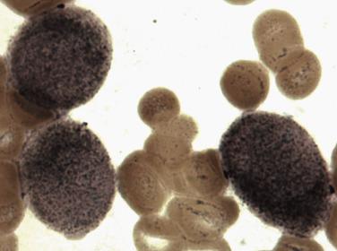 FIG. 22.48, Nonspecific esterase histochemical staining of a bone marrow aspirate smear from a case of acute monocytic leukemia showing intense staining of the cytoplasmic contents.