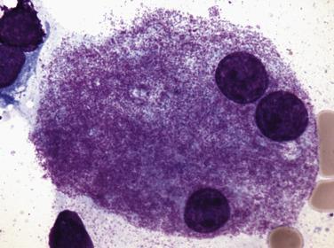 FIG. 22.5, Bone marrow aspirate smear in myelodysplastic syndrome with multilineage dysplasia demonstrating a dysplastic megakaryocyte with a so-called pawn-ball appearance. (Wright-Giemsa stain.)