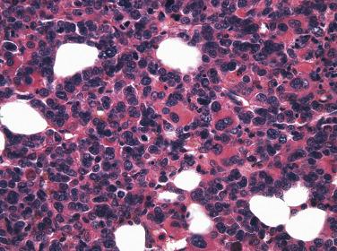 FIG. 22.51, Histologic section of a bone marrow core biopsy from a case of acute megakaryoblastic leukemia showing sheets of large megakaryoblasts and admixed large atypical megakaryocytes. (Hematoxylin and eosin stain.)