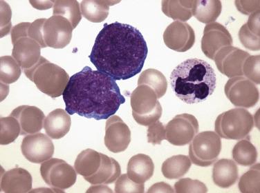 FIG. 22.52, Bone marrow aspirate smear in acute megakaryoblastic leukemia showing two megakaryoblasts and small amounts of basophilic cytoplasm with distinct membrane blebbing. (Wright-Giemsa stain.)