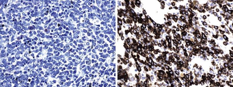 FIG. 22.53, Histologic section from a case of pure erythroid leukemia showing a markedly hypercellular marrow with sheets of immature erythroid cells; note the absence of maturation and myeloid and megakaryocytic elements ( left panel: Giemsa stain). The immature cells are positive for CD71, transferrin receptor expressed on erythroid precursors (right panel).