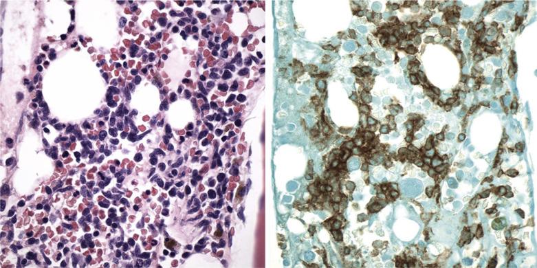 FIG. 22.54, Histologic section of a bone marrow biopsy from a case of blastic plasmacytoid dendritic cell neoplasm showing an infiltrate of small immature mononuclear cells with irregular nuclei and scant cytoplasm ( left panel: Hematoxylin and eosin). The blasts are positive for CD123, a marker of plasmacytoid dendritic cells (right panel).