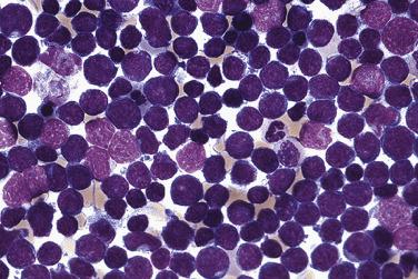 FIG. 22.55, Bone marrow aspirate smear in B-lymphoblastic leukemia showing a predominant population of small lymphoblasts with even chromatin and scant agranular basophilic cytoplasm. (Wright-Giemsa stain.)