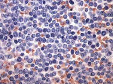 FIG. 22.56, Histologic section of a bone marrow core biopsy in B-lymphoblastic leukemia, showing diffuse marrow involvement by small lymphoid blasts with finely dispersed chromatin, indistinct nucleoli, and scant cytoplasm. (Giemsa stain.)