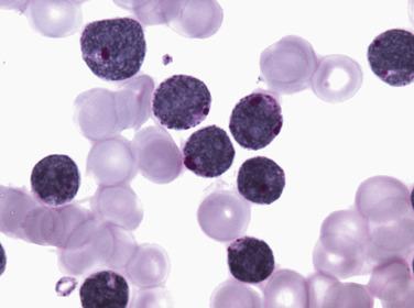 FIG. 22.57, Periodic acid–Schiff (PAS) histochemical staining of a bone marrow aspirate smear from a case of B-lymphoblastic leukemia showing prominent blocklike cytoplasmic staining.