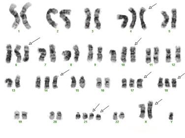 FIG. 22.58, Karyotypic analysis demonstrating hyperdiploidy ( n = 55) in a precursor B-cell acute lymphoblastic leukemia.