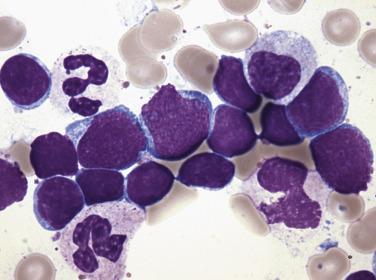FIG. 22.59, Bone marrow aspirate smear showing increase in nonneoplastic, functional B-cell precursors (hematogones). Note the similarities in morphologic appearance to neoplastic B lymphoblasts (see Fig. 22.55 ). The variations in cell size and chromatin pattern, together with their characteristic immunophenotypic profile, are clues to the identification of these hematogones. (Wright-Giemsa stain.)