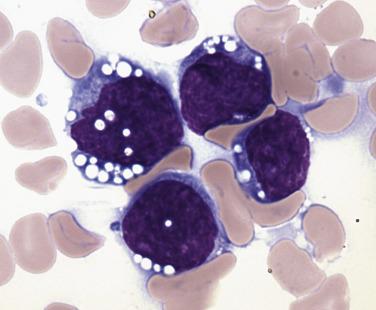 FIG. 22.60, Bone marrow aspirate smear in Burkitt lymphoma/leukemia. Compared with B-lymphoblastic leukemia, these cells are larger, demonstrate more nuclear hyperchromasia, and show prominent cytoplasmic vacuolization. (Wright-Giemsa stain.)