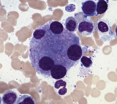 FIG. 22.6, Bone marrow aspirate smear demonstrating a large dysplastic megakaryocyte in a case of myelodysplastic syndrome with excess blasts. (Wright-Giemsa stain.)