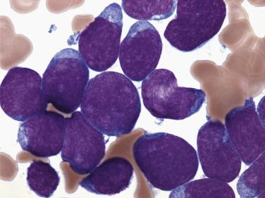 FIG. 22.61, Bone marrow aspirate smear in T-lymphoblastic leukemia showing numerous lymphoblasts with nuclear irregularities, dispersed chromatin, occasionally distinct nucleoli, and small amounts of agranular basophilic cytoplasm. (Wright-Giemsa stain.)