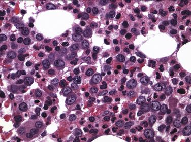 FIG. 22.7, Histologic section of a bone marrow core biopsy from a patient with severe folate deficiency and megaloblastic anemia mimicking a myelodysplastic syndrome. (Hematoxylin and eosin stain.)