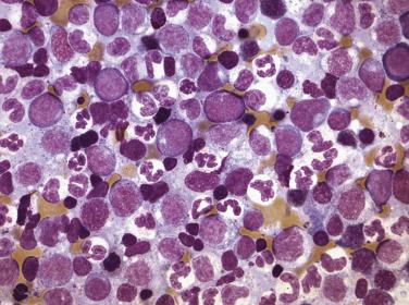 FIG. 22.8, Bone marrow aspirate smear in chronic myelomonocytic leukemia showing frequent neutrophils, early and late monocytic forms, and occasional myeloblasts. (Wright-Giemsa stain.)
