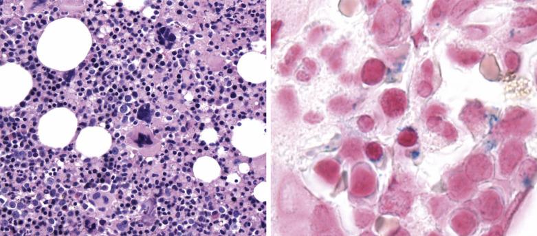 FIG. 22.9, Histologic section of a clot specimen from a case of myelodysplastic/myeloproliferative neoplasm with ring sideroblasts and thrombocytosis showing hypercellular marrow with erythroid and megakaryocytic hyperplasia and dysmegakaryopoiesis (hypolobate and hyperchromatic forms). ( Left panel: Hematoxylin and eosin stain.) Iron stain performed on the clot section shows numerous ring sideroblasts. ( Right panel: Iron stain.) Molecular analysis showed the presence of SF3B1 K666N and JAK2 V617F mutations.