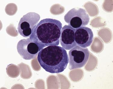 FIG. 22.10, Bone marrow aspirate smear in myelodysplastic syndrome with single lineage dysplasia (refractory anemia) showing megaloblastoid erythroid differentiation and nuclear irregularities. Dysplasia was absent in nonerythroid lineages, in this case consistent with a diagnosis of MDS with single lienage dysplasia. (Wright-Giemsa stain.)