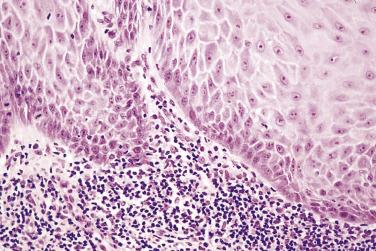 FIG. 6.12, High-power view of advancing edge of a verrucous carcinoma. The lesion has a well-demarcated pushing invasive pattern.
