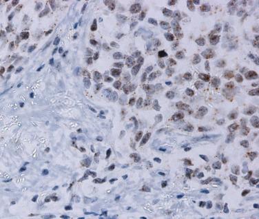 FIG. 6.13, RNA in situ hydridization for HPV infection (E6/E7). The tumor nuclei show a speckled dotlike pattern of staining indicative of transcriptionally active virus.