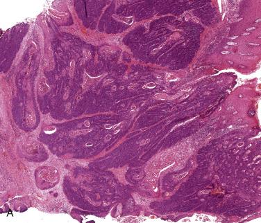 FIG. 6.14, HPV-associated nonkeratinizing carcinoma. (A) The lesion has a basaloid morphology. (B) Immunocytochemistry for p16 is strongly positive.