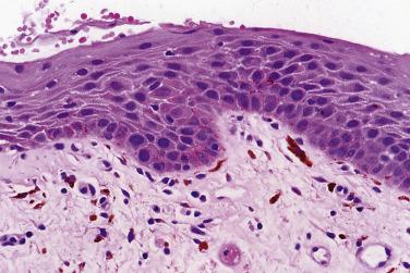 FIG. 6.16, Mild dysplasia with changes confined to the deepest third of the epithelium and only mild cytologic changes. The pigmentation is reactive melanosis related to smoking in this floor-of-mouth lesion.