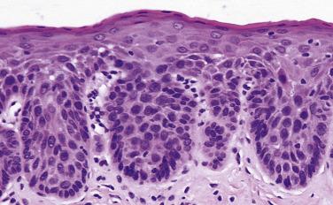 FIG. 6.17, Moderate dysplasia. The prominent drop-shaped rete ridges show moderate cytologic changes which extend into the middle third of the epithelium.