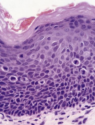 FIG. 6.18, Severe dysplasia. Architectural change extends into the superficial third of the epithelium with increased and abnormally superficial mitoses.