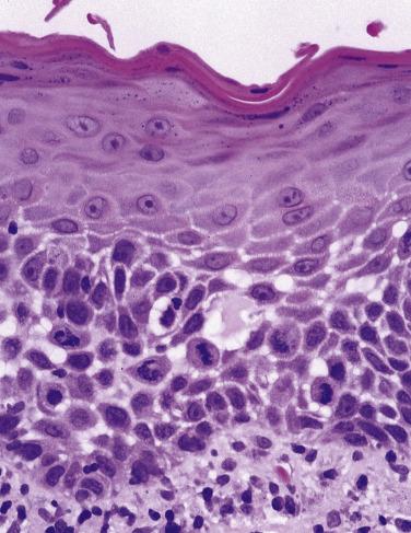 FIG. 6.19, Moderate epithelial dysplasia recategorized as severe. Although the architectural change appears restricted to the lower two-thirds of the epithelium, the magnitude of cytologic change justifies this lesion being recategorized as severe dysplasia.