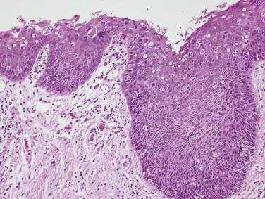 FIG. 6.20, Carcinoma in situ. Architectural and cytologic changes involve the full thickness of the epithelium.