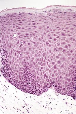 FIG. 6.2, Mitosoid bodies are frequently seen in focal epithelial hyperplasia.