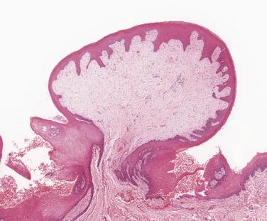 FIG. 6.21, A fibroepithelial polyp is pedunculated and composed of collagenous fibrous tissue covered by variably hyperplastic epithelium.