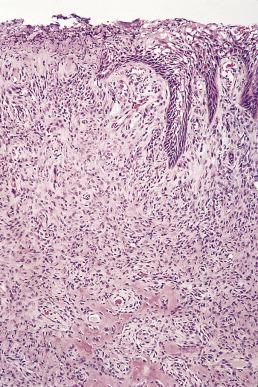 FIG. 6.22, Fibrous epulis showing a mass of very cellular fibrous tissue and bone formation. Frequently there is ulceration of the surface epithelium, and the superficial parts of the lesion consist of granulation tissue.