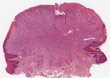 FIG. 6.23, Pyogenic granuloma showing a widely ulcerated surface overlying inflamed granulation tissue. Toward the deep aspect there are lobules of proliferating vessels.