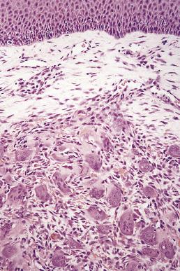 FIG. 6.24, Giant cell epulis with numerous multinucleate giant cells in a vascular stroma.