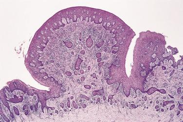 FIG. 6.25, Papillary hyperplasia of palate with irregular epithelial overgrowth giving a low-power impression of invasion.