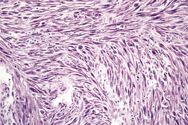 FIG. 6.3, Spindle cell carcinoma exhibiting a highly mesenchymal appearance.