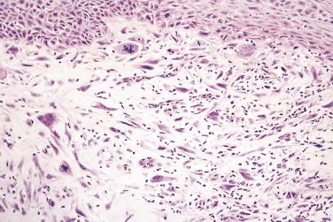 FIG. 6.4, Bizarre cytology in dispersed tumor cell population of a spindle cell carcinoma. Note the adjacent dysplastic surface epithelium.