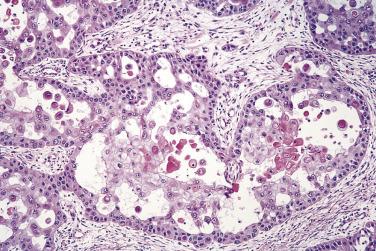 FIG. 6.5, Adenoid squamous cell carcinoma with loss of intercellular adhesion within tumor islands, resulting in a pseudoglandular appearance.