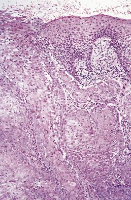 FIG. 6.6, Adenosquamous carcinoma showing a field of conventional squamous cell carcinoma arising from surface epithelium.