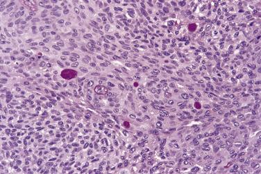 FIG. 6.8, Squamous cell carcinoma with a small number of mucus-secreting cells. Diastase–periodic acid–Schiff.