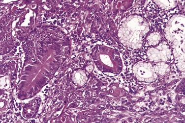 FIG. 6.9, Squamous cell carcinoma invading minor salivary gland in the tongue. Note that the acinar tissue and the ducts are from existing gland and not part of the tumor, although one duct shows squamous metaplasia.