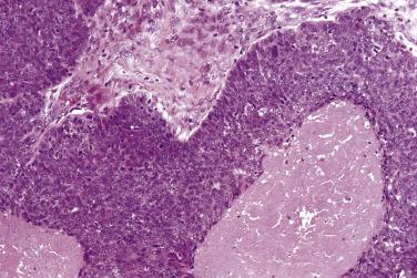 FIG. 6.10, Basaloid squamous cell carcinoma showing islands of basal cells with comedo necrosis.