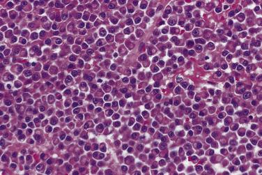 FIG. 25.1, Myeloma composed of neoplastic plasma cells with eccentrically placed nuclei, eosinophilic cytoplasm, and perinuclear clearing.