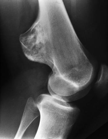 FIG. 25.11, Radiograph of an osteochondroma projecting from the femoral metaphysis. Note the continuity of the cortical and cancellous bone from the underlying femur to the lesion.